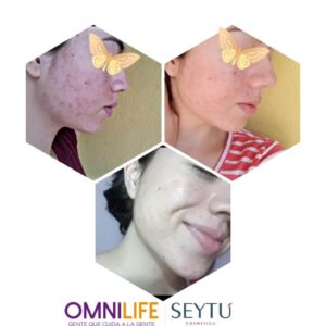 cicatrices de acne antes y despues